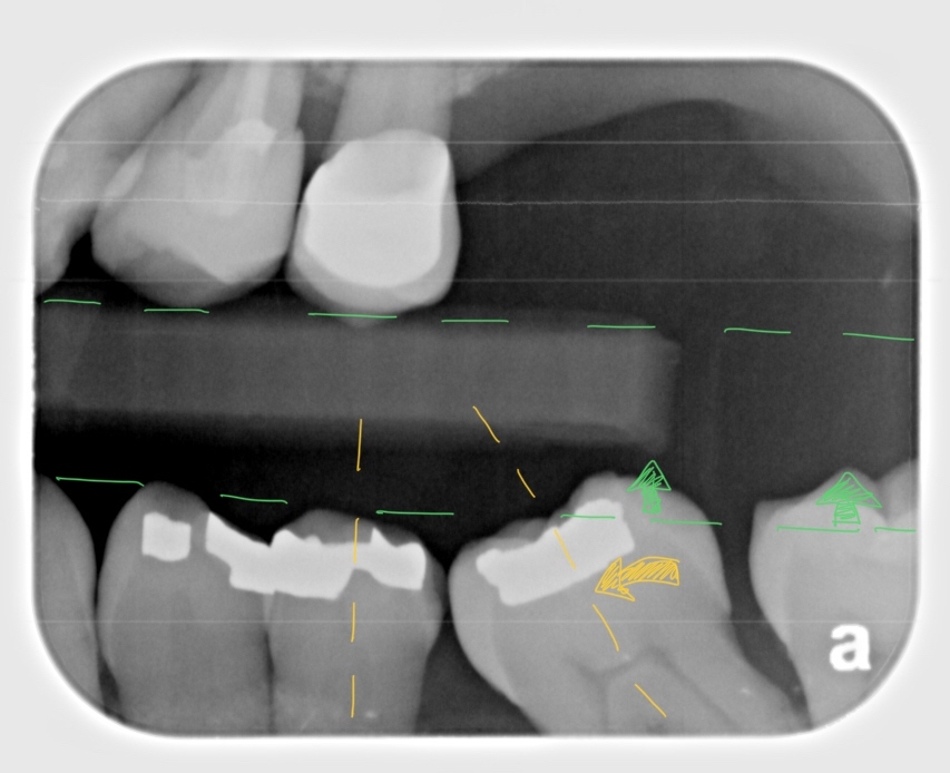  Unwanted Drifting of Teeth (Fig1)